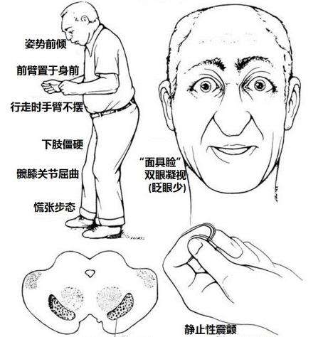 【世界帕金森病日專題】-原發(fā)性帕金森病與帕金森綜合癥的區(qū)別 【世界帕金森病日專題】-原發(fā)性帕金森病與帕金森綜合癥的區(qū)別
