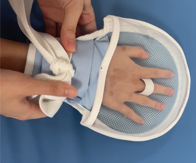 蒙泰轉(zhuǎn)化護(hù)士創(chuàng)新的“透明型”約束手套