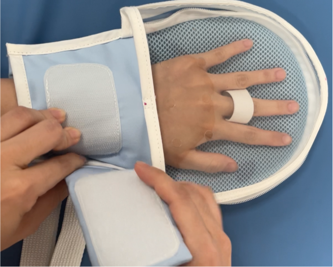 蒙泰轉(zhuǎn)化護(hù)士創(chuàng)新的“透明型”約束手套